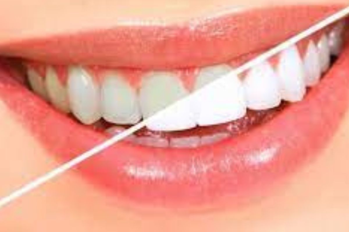 दांतों का पीलापन इन घरेलू उपाय से करें दूर, मोती की तरह चमकेंगे दांत